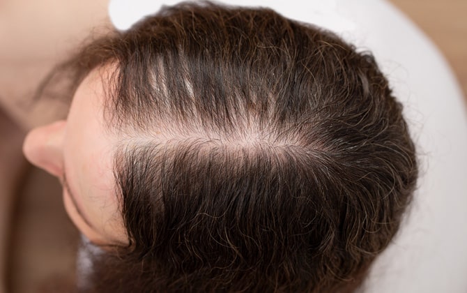 Femme qui souffre de perte de cheveux (alopécie androgénétique)