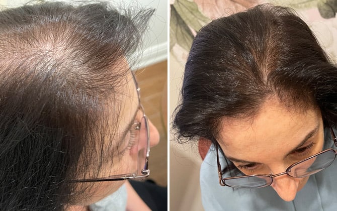 Femme souffrant de perte de cheveux - avant et après les soins en trichologie