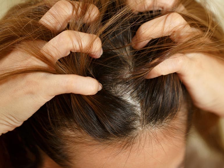 Femme qui se gratte en raison. d'un cuir chevelu sec