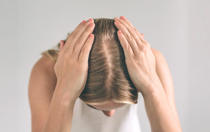 Femme ayant une perte capillaire sur le dessus de la tête