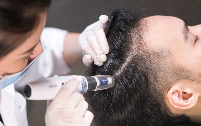 Traitement de mésothérapie contre la perte de cheveux