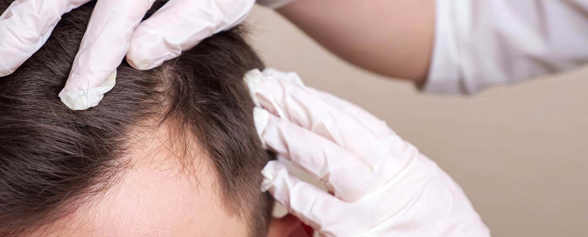 Consultation pour la calvitie et la perte de cheveux chez l'homme