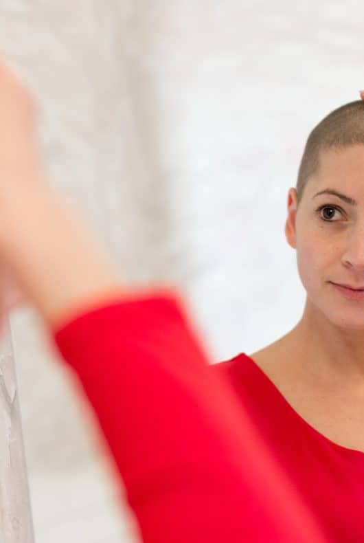Jeune femme qui a perdu ses cheveux à la suite de traitements de chimiothérapie