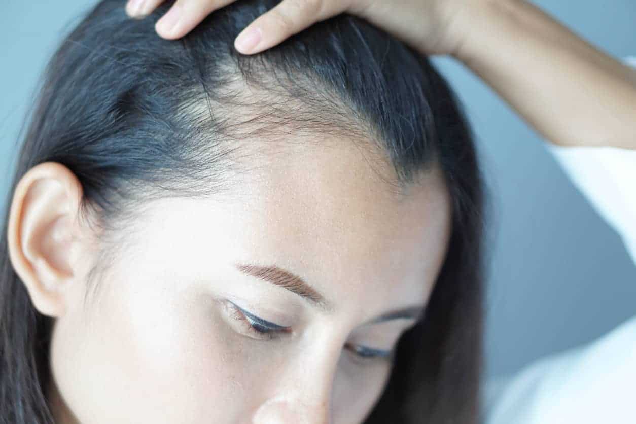 Femme souffrant de perte de cheveux qui opte pour le traitement Alma TED