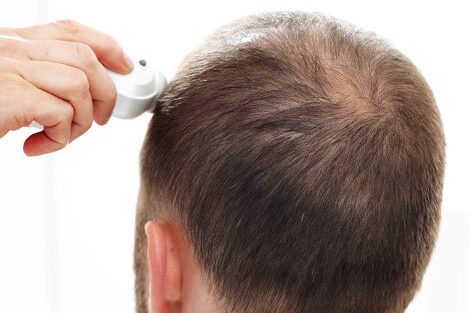 Homme consultant pour une calvitie naissante